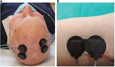 AKASI and Near-Infrared Spectroscopy in the combined effectiveness evaluation of an actinic keratoses preventive product in immunocompetent and immunocompromised patients